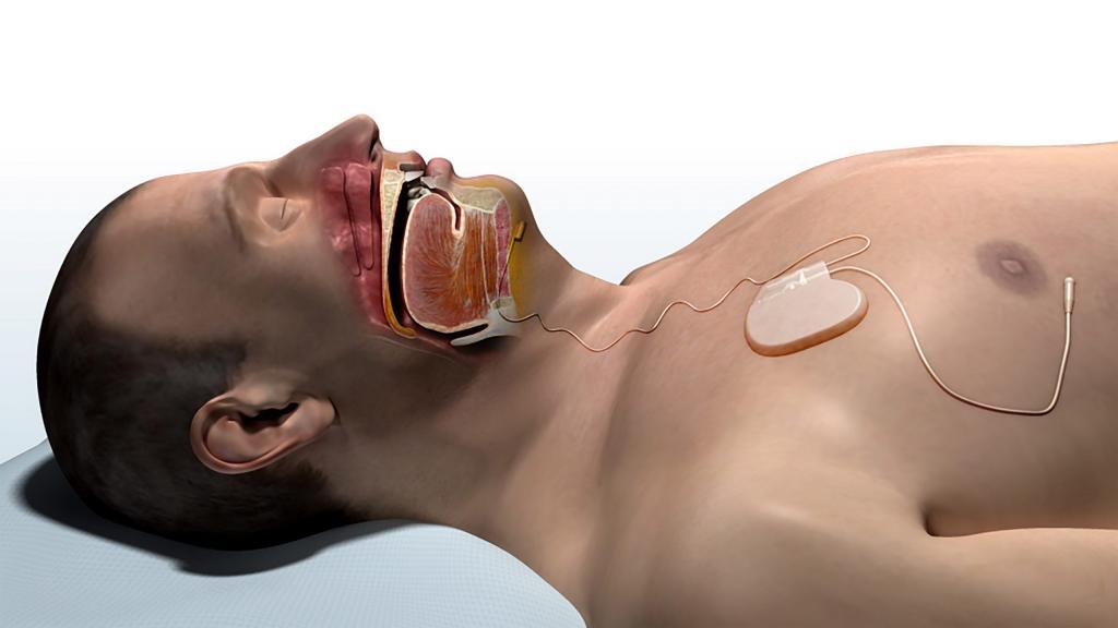 Inspire Normal Breathing with Inspire original 1024x576 - Upper Airway Stimulation: Expensive but Worth It?