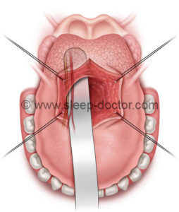 MLG3 254x300 - New Research--Treating the Large Tongue in Sleep Apnea Surgery