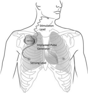 Inspire1 284x300 - Does drug-induced sleep endoscopy identify candidates for electrical nerve stimulation for sleep apnea?