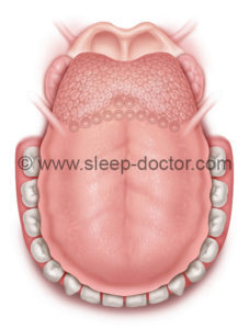 MLG1 227x300 - New Research--Treating the Large Tongue in Sleep Apnea Surgery