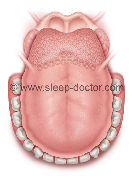 MRI shows slimmer tongue reduces sleep apnea