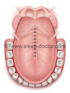 Sleep Apnea Surgery Treating Tongue