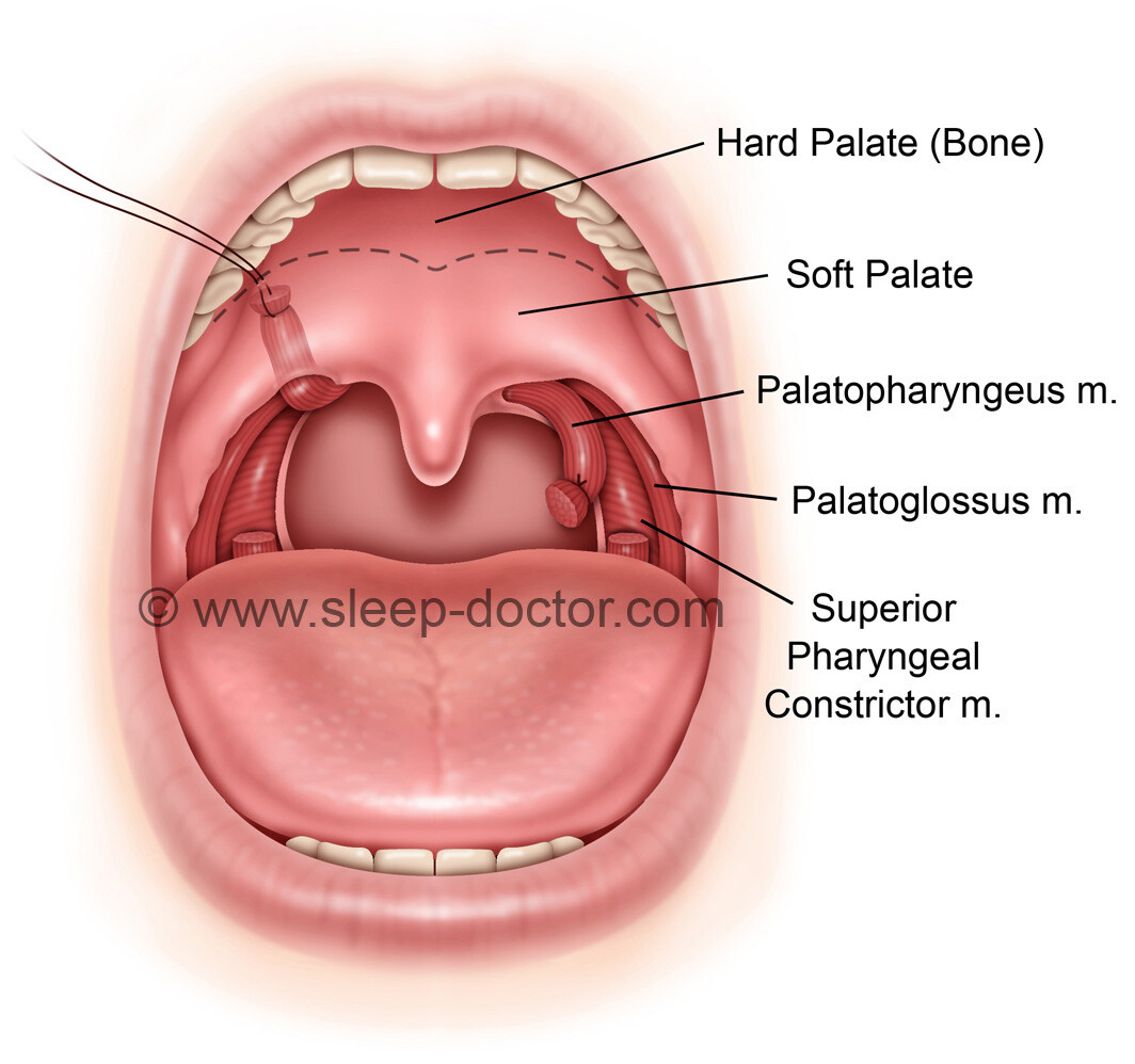 expansion sphincter pharyngoplasty intermediate - Modified Expansion Sphincter Pharyngoplasty--A True International Effort