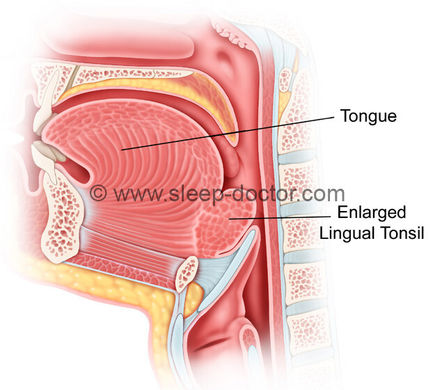 lingual tonsils model