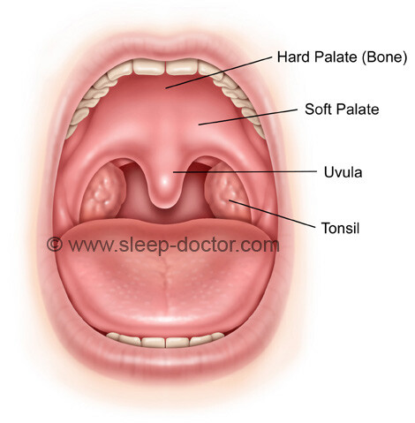 palate surgery - Uvulopalatoplasty (Cautery-Assisted)