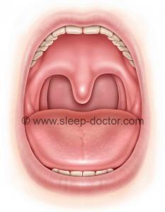 palatopharyngoplasty 233x300 - Palate surgery with small or absent tonsils: new research and a key to good results