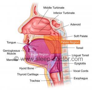 sleep diagram 2regions 300x293 - DISE can change the treatment plan in obstructive sleep apnea surgery