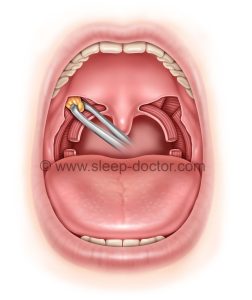 Australian mid 252x300 - Australian Modified Palatopharyngoplasty