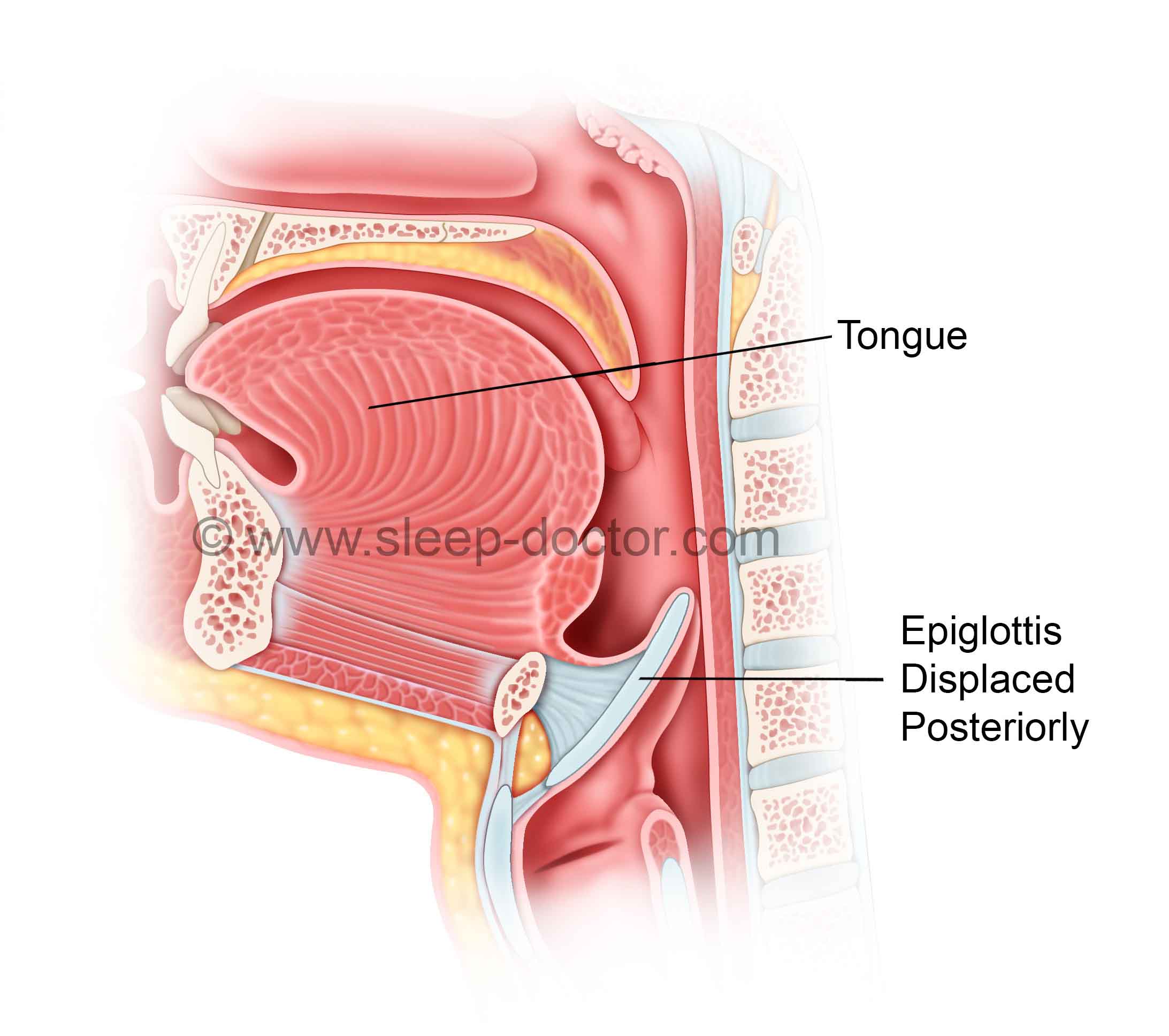 Epiglottis Surgery - Sleep Doctor