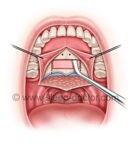PAP 2 Elevation 268x300 - Palatal Advancement