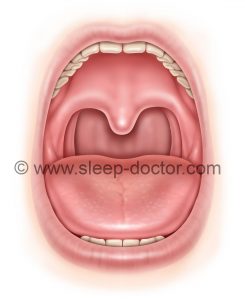 Palatopharyngoplasty Postop 245x300 - Australian Modified Palatopharyngoplasty