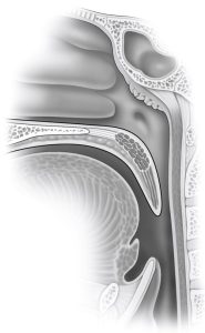 Woodson Narrow GenuAP 185x300 - Palate shape is associated with palate surgery outcomes
